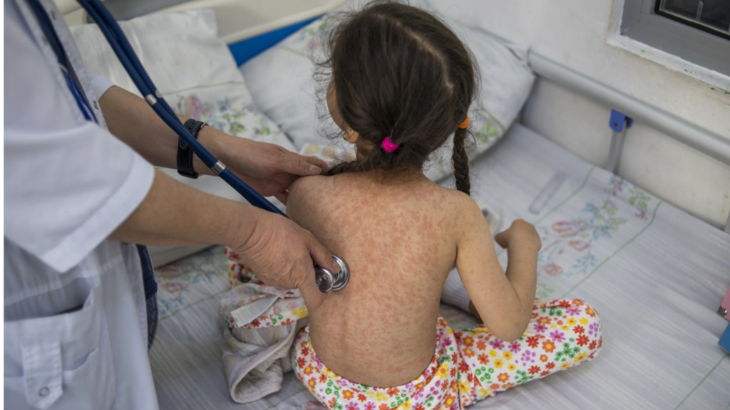 Niñas de 0 a 4 años las más afectadas por repunte de sarampión en México