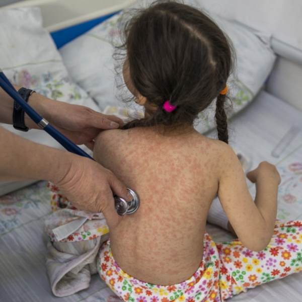 Niñas de 0 a 4 años las más afectadas por repunte de sarampión en México