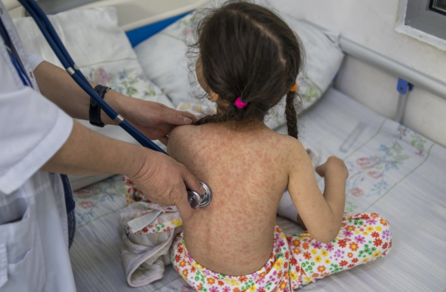 Niñas de 0 a 4 años las más afectadas por repunte de sarampión en México